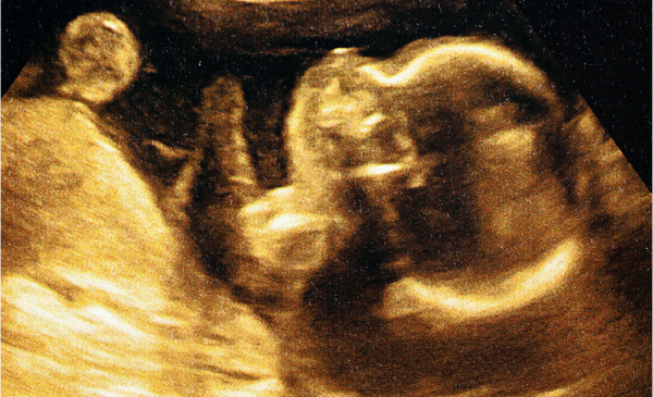 Pregancy scan